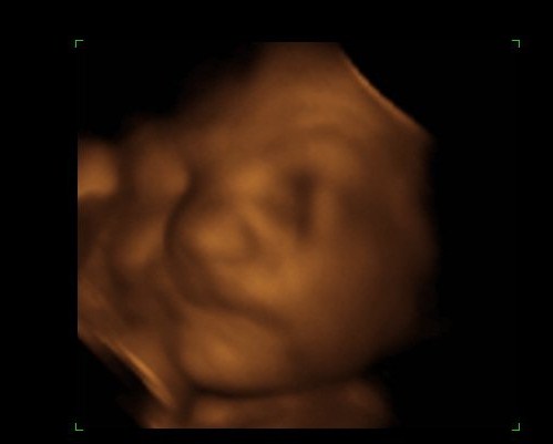 11 weeks pregnant. 11 weeks pregnant ultrasound